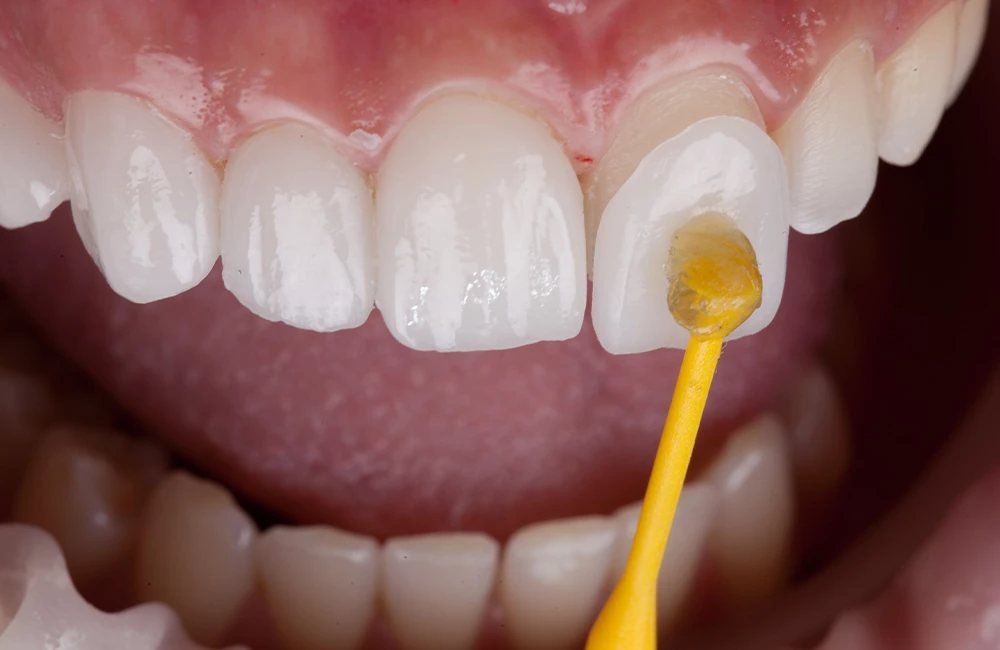 Porcelain Veneers at Smile Studio Boston