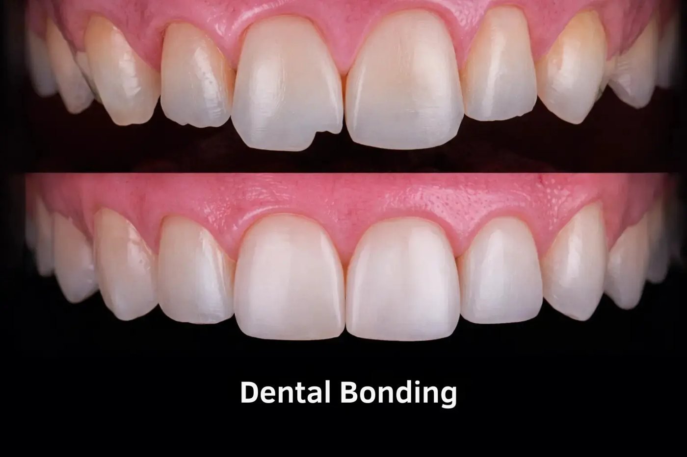 Bonding at Smile Studio Boston
