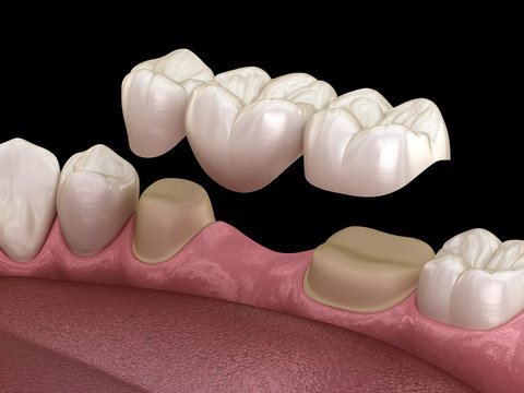 Crowns & Bridges at Smile Studio Boston