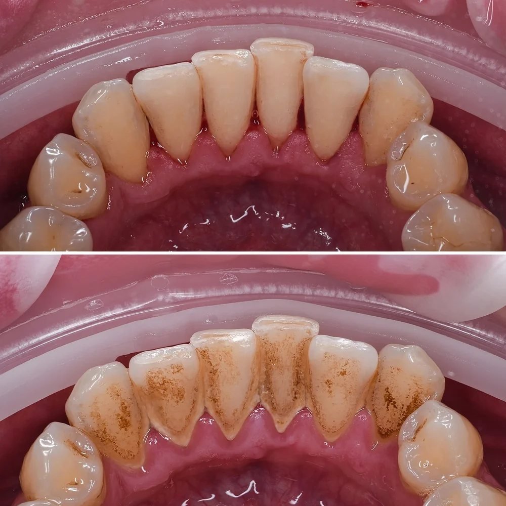 Dental Cleaning at Smile Studio Boston