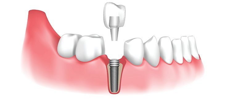 Dental Implants at Smile Studio Boston