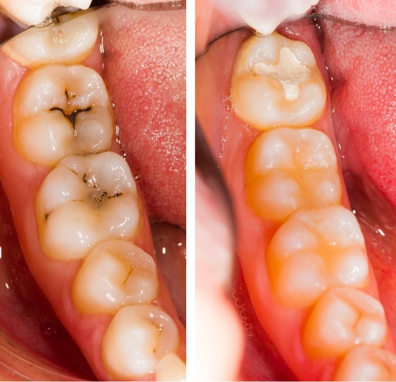 Fillings at Smile Studio Boston